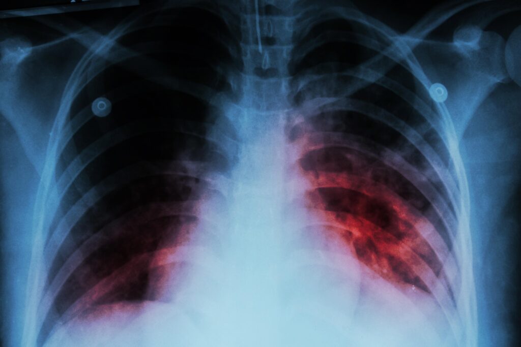 3 INTERESTING FACTS ABOUT TUBERCULOSIS visual data 6